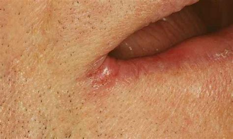 sore in corner of mouth causes treatment pictures healing