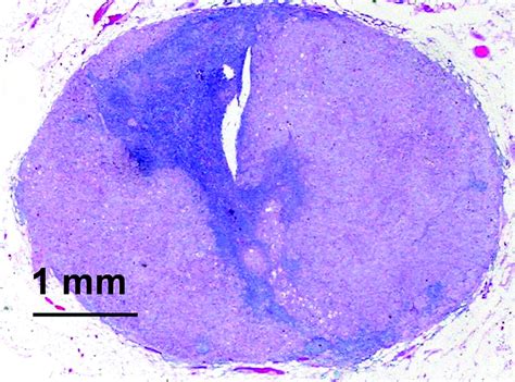 Pelvic Lymph Nodes Distribution And Nodal Tumour Burden Of Urothelial