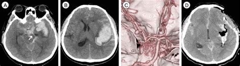 Ct And Ct Angiography In Case 2 A C Sah And Intrasylvian Hematoma