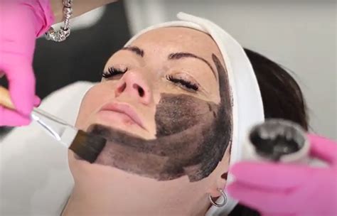 Carbon Laser Facial Benefits How It Works And Side Effects