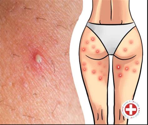 Get Rid Of Boils On Your Thighs And Buttocks Health