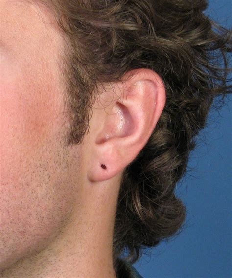 Gauge Earring Repair Torn Earlobe Repair