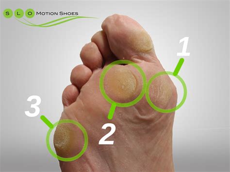 The Anatomy Of A Callus Slo Motion Shoes