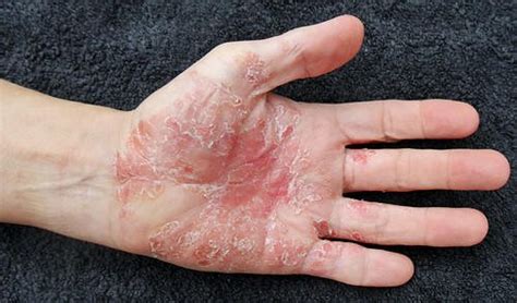 Treatment Of Palmoplantar Psoriasis Best Homeopathy Doctor In India