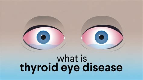What Is Thyroid Eye Disease American Association Of Clinical