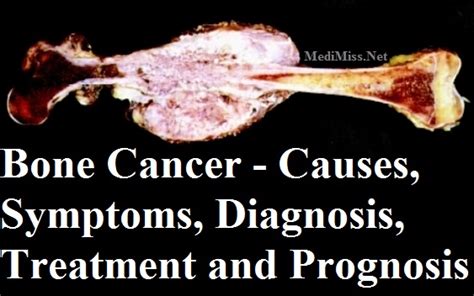 Bone Cancer Symptoms Cancer Causes What Causes Bone Cancer News