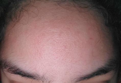 Skin Concerns My Forehead Has Always Had A Weird Texture That Feels A