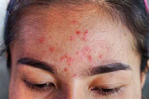 Hair Patch Test 101 Avoid Allergic Reactions To Hair Dyes And Other
