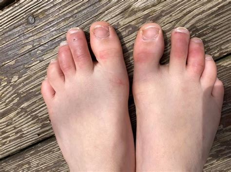 Dermatologist Explains If Covid Toes Skin Rashes Are Symptoms Tied