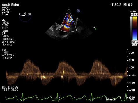 Continuous Wave Doppler Echocardiography Of The Pulmonic Valve Shows A