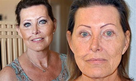 My Face Was Wrecked By Skin Cancer But My Plastic Surgeon Left Me