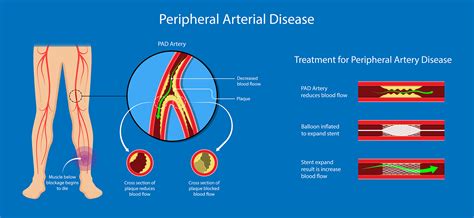 Peripheral Arterial Disease Symptoms And Causes Dr Raghu
