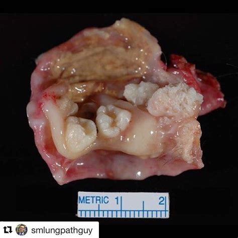 5 however, this case series provides two clinical examples of pathologically proven sizeable benign dermoid cysts in which prior ct examination failed to demonstrate their macroscopic preexistence, indicating much more rapid growth than 1.8 mm/year. This is an ovary tumor. Can you see the fully grown teeth ...