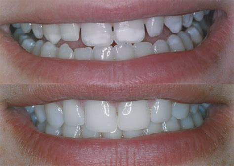 Cosmetic Veneers And Composite Bonding — Oasis Dentistry