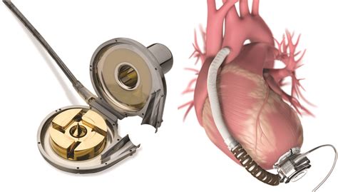 Overview Of Left Ventricular Assist Devices Lvads Ed Ecmo