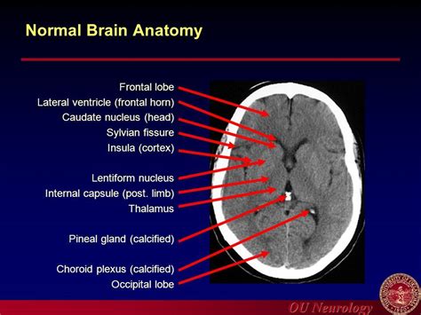 Axial View Of A Head Computed Tomography Ct Scan Of Pineal Gland