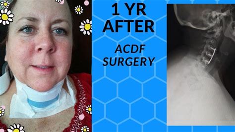 1 Yr Post Acdf Surgery Update 3 Level C 3 C7 Cervical Fusion Surgery