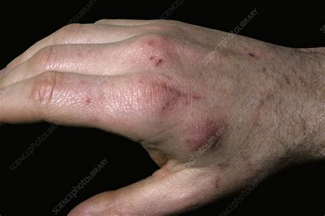 Cat Scratch Disease Stock Image C0515374 Science Photo Library