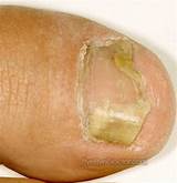 Fingernail Eczema Treatment Photos