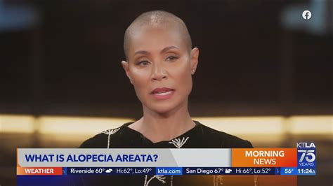 Jada Pinkett Smith Shares Struggle With Alopecia Youtube