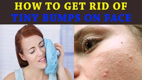How To Get Rid Of Tiny Bumps On Face How To Get Rid Of Pimples In 5