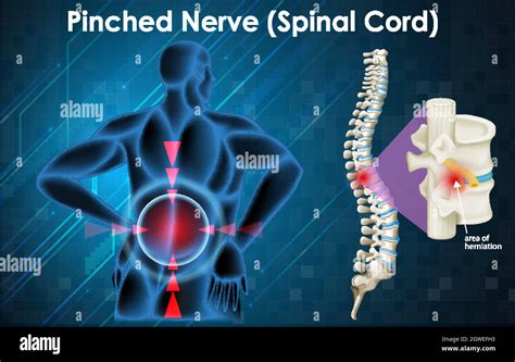 Diagram Showing Pinched Nerve On Human Stock Vector Image And Art Alamy