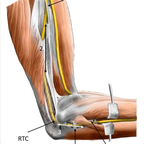 Right Ulnar Nerve Transposition Surgery