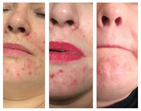 Microdermabrasion Before And After Acne Treatment Microdermabrasion