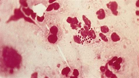 super gonorrhoea has spread across england doctors warn the week