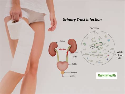 What Is Urinary Tract Infection Uti Here Are Its Causes Symptoms Treatment And Preventive