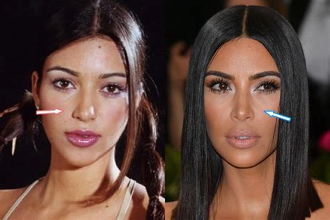 Kim Kardashian Nose Job Before And After Surgery Job Kardashian
