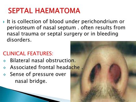 Ppt Nasal Septum And Its Diseases Powerpoint Presentation Free Download Id
