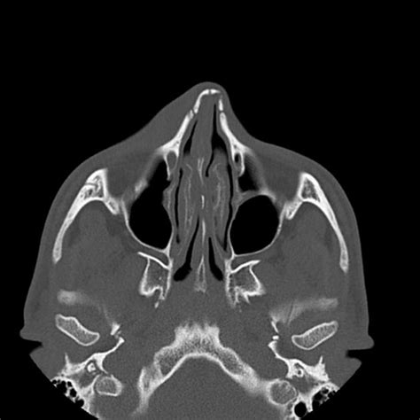 Nasal Bone Fracture Radiology Case Bone Fracture