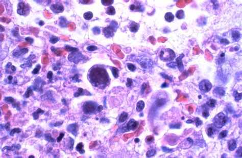 Cytomegalovirus Infection Basophilic Nuclear Inclusions Flickr