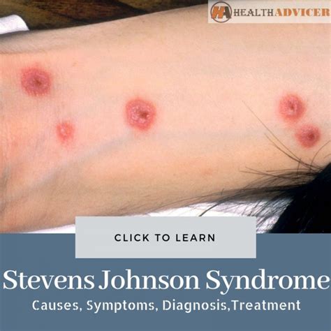 Stevens Johnson Syndrome Causes Symptoms Diagnosis And Treatment