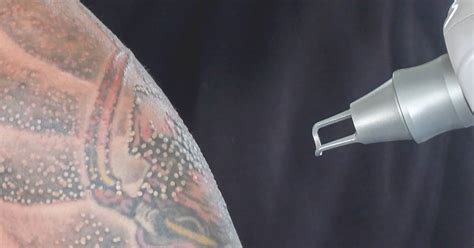 17 Key Facts You Must Know About Tattoo Removal In Singapore