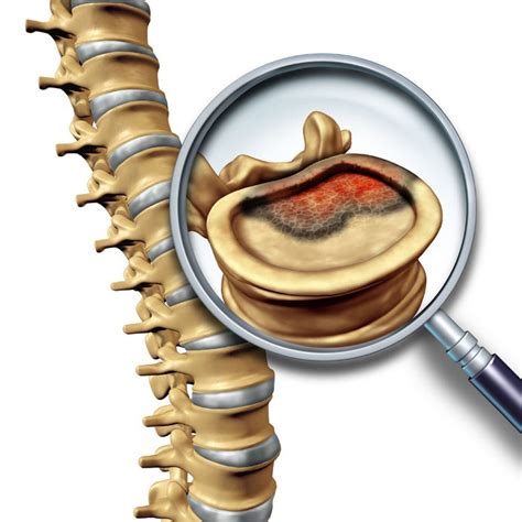 While most spinal pain is located in the lower back or neck, pain from a spinal tumor is more likely to be felt in the upper or middle back. Spinal Chondrosarcoma is a Primary Bone Cancer