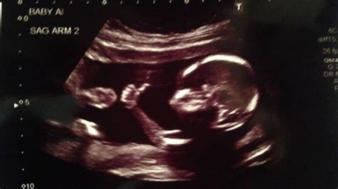 Sonogram Showing Baby Giving Thumbs Up In The Womb Goes Viral Abc11