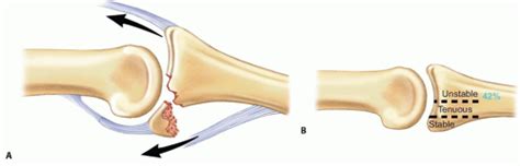 Dynamic External Fixation Of Proximal Interphalangeal Joint Fracture