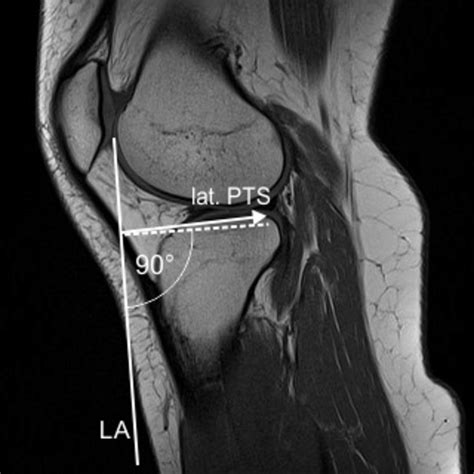 Mr Pd Sagittal Image Of Central Lateral Tibial Plateau Used For The