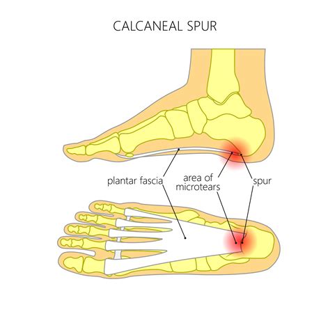 Common Causes Of Heel Pain Plantar Fasciitis And Heel Spurs The Buxton