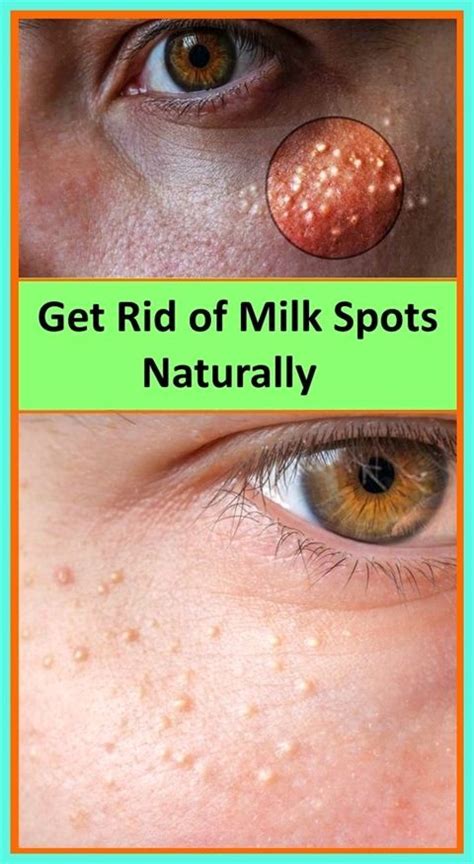7 Remedies To Get Rid Of Cholesterol Milk Spots Naturally In 2021