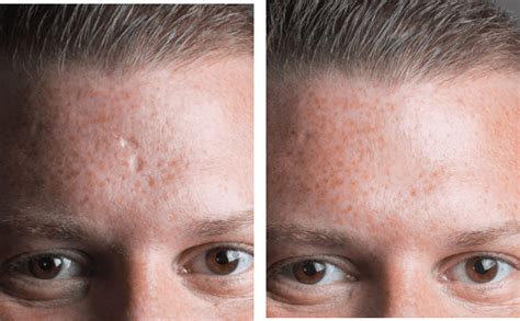 Mederma Acne Scars Before And After