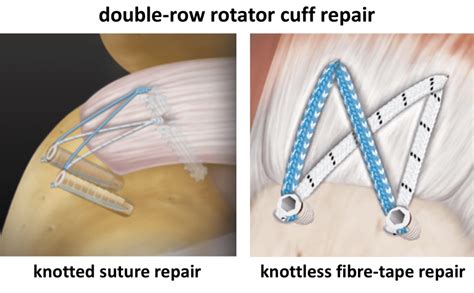 Fig 16 Double Row Rotator Cuff Repairs Cambridge Shoulder