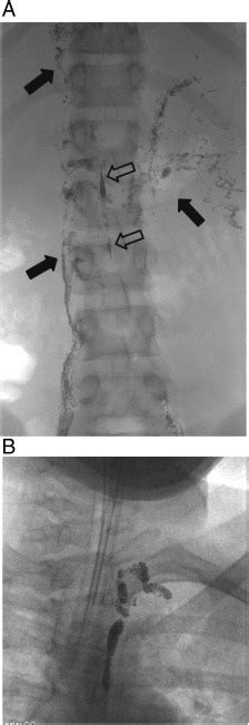 Lymphaticovenous Bypass Of The Thoracic Duct For The Treatment Of