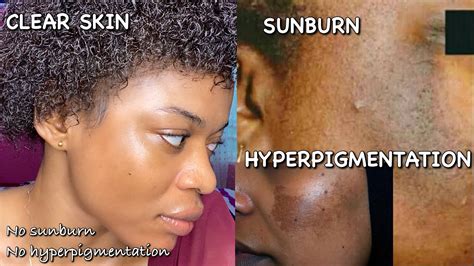 The Difference Between Sunburn And Hyperpigmentation The Confusion