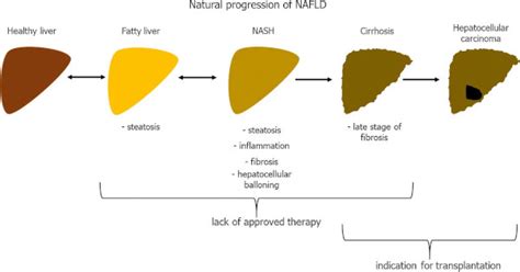 Nafld Is Dramatically Growing As A Cause Of Hepatocellular Carcinoma