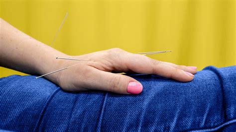 Acupuncture For Psoriasis Does It Help