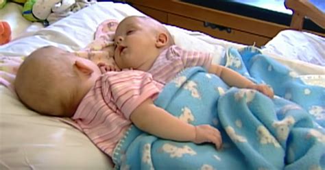 10 Years Ago These Conjoined Twins Were Separated Through Advanced