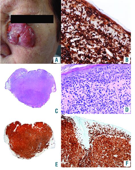 Alk Negative Primary Cutaneous Anaplastic Large Cell Lymphoma With